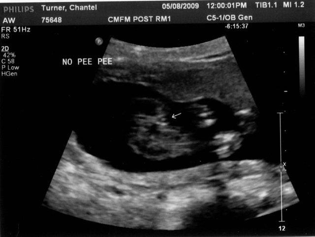 18week gender1