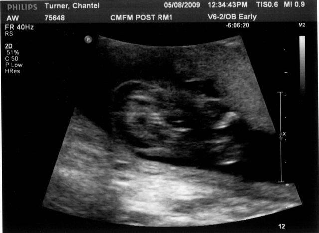 18week gender2